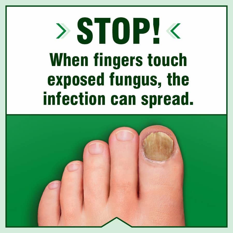 Anti-Fungal Liquid Topical Formula Maximum Strength