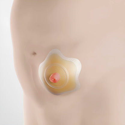 Coloplast SenSura Mio Concave 2 piece Click Baseplate Item 18511