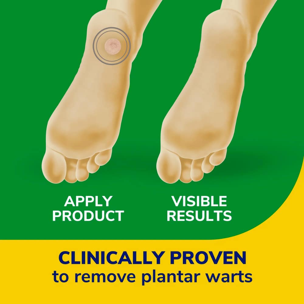 wart remover for daily use